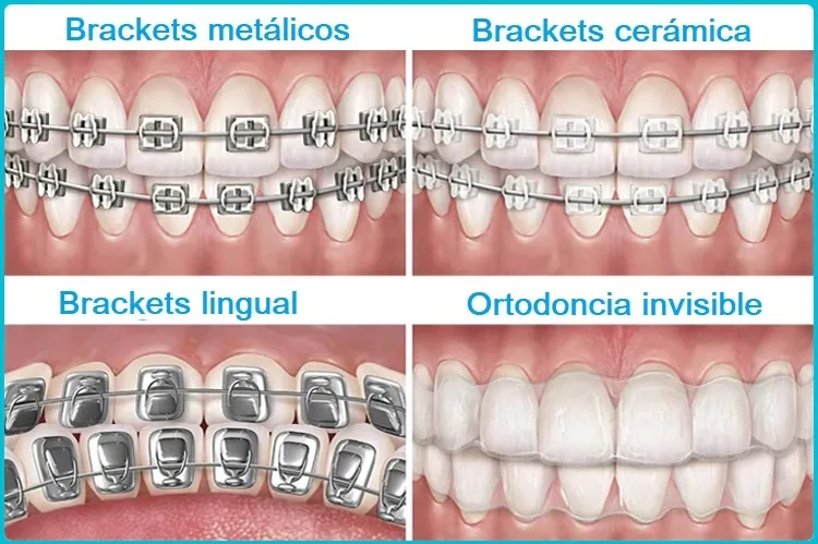 Ortodoncia invisible en Benetússer